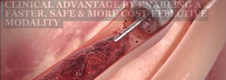 Removing Blood Clots From Arteries and Veins