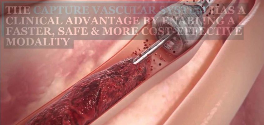 Removing Blood Clots From Arteries and Veins